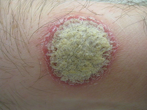 psoriasis plaque pictures