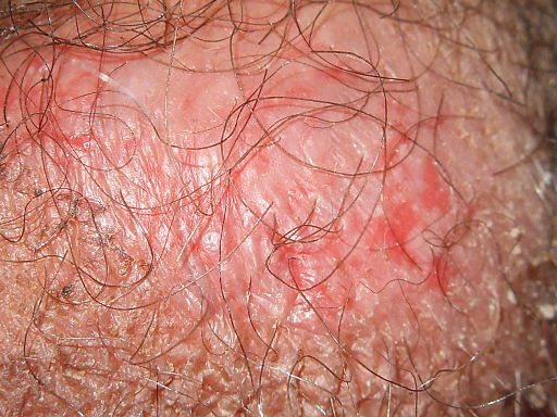 psoriasis pictures