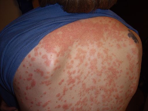 psoriasis pictures