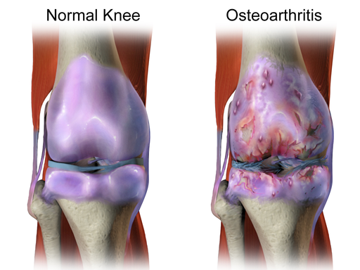 what types of arthritis can cause knee pain