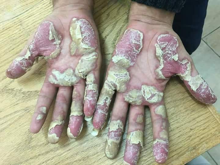 psoriasis pictures