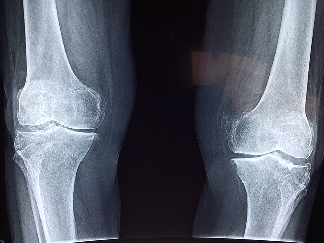 mechanical issues can cause knee pain