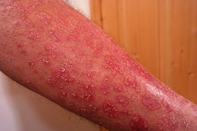 about what is psoriasis