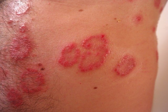 ERYTHRODERMIC PSORIASIS