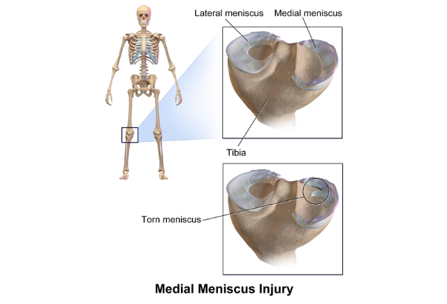 causes of knee pain